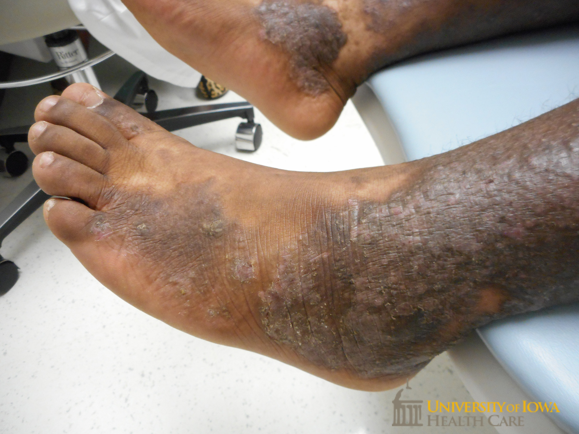 Hyperpigmented to erythematous lichenified scaly plaques on the dorsal feet and legs. (click images for higher resolution).